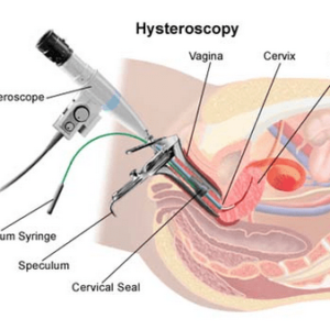 Hysteroscopic Surgery