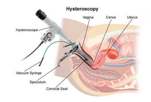Hysteroscopic Surgery