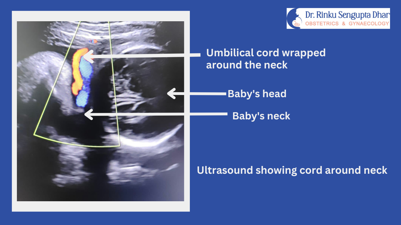 Cord Around the Neck Should I Worry? Dr. Rinku Sengupta Dhar